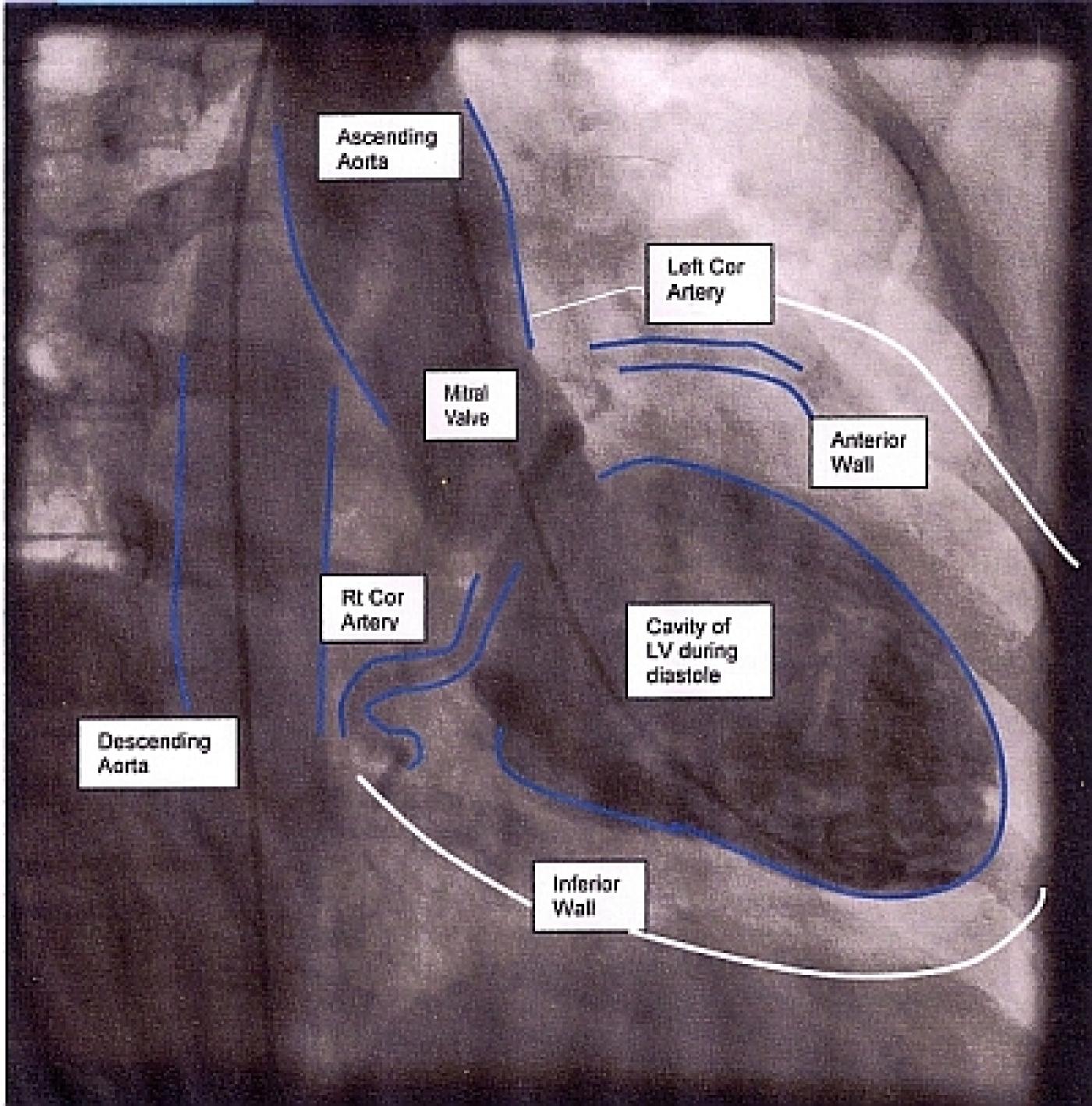 Using Ventriculograms to Enhance Your ECG Classes ECG Guru